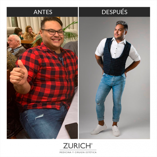 Antes y despu�s bal�n g�strico 12 meses